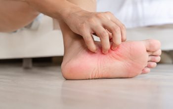 Penyebab Gatal di Telapak Kaki dan Cara Mengatasinya
